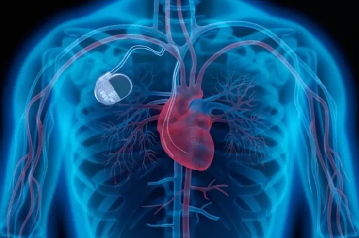 Cardiac Device Implantation