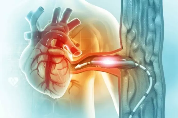 Complex Coronary Angioplasties