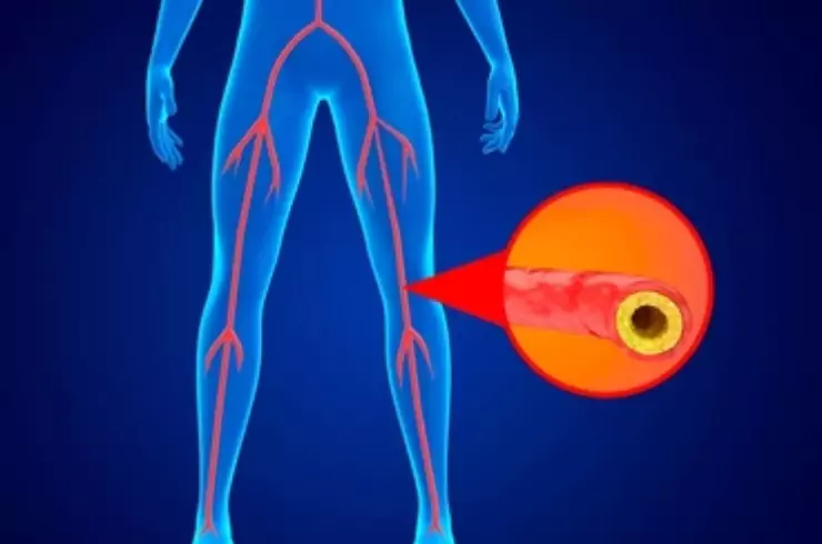 Peripheral & Aortic Vascular Interventions